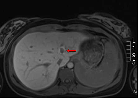 Figure 2. T1 weighted MRI (axial view).